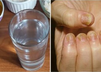 4 remèdes naturelles pour traiter les mycoses des ongles