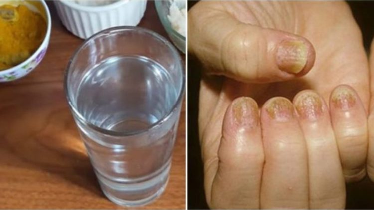 4 remèdes naturelles pour traiter les mycoses des ongles