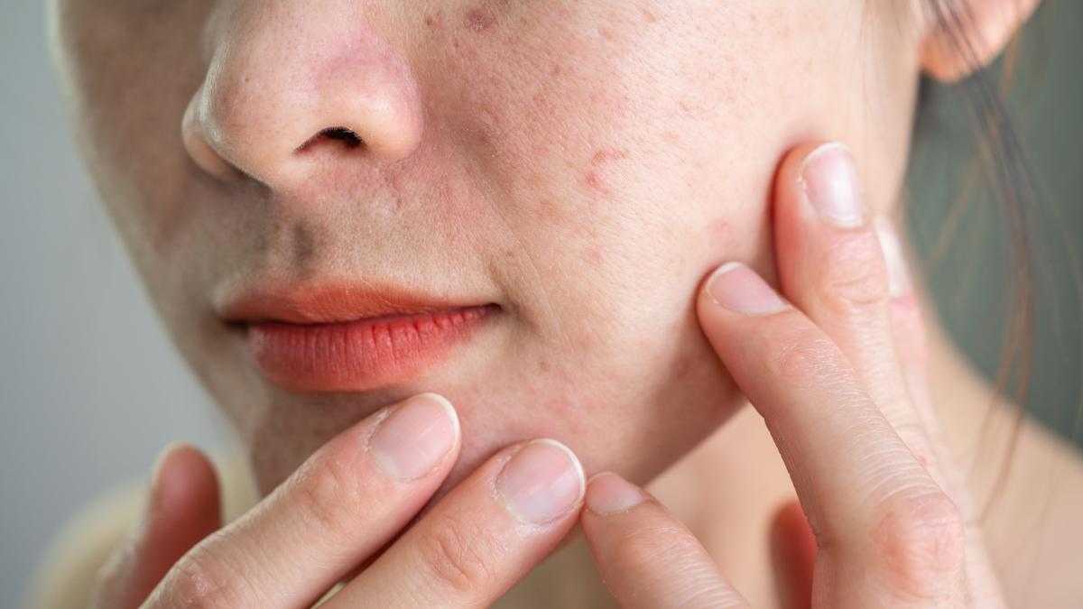 Stress : c'est pourquoi vous avez une éruption cutanée sur le visage